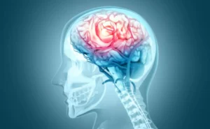 Blog 9 » causas de un accidente cerebrovascular- clinica de neurologia robotica