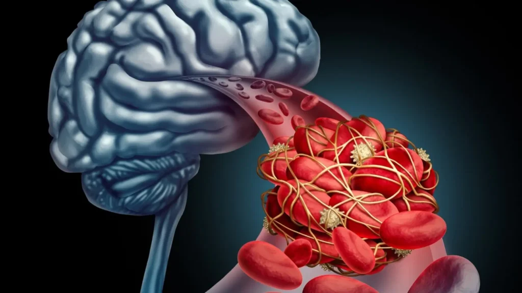 ¿Qué es un accidente cerebrovascular? Y por qué es importante detectarlo a tiempo 1 » Accidente cerebrovascular,Que es un accidente cerebrovascular,Tipos de accidentes cerebrovasculares,Síntomas de un accidente cerebrovascular,Rehabilitación robótica cerebro con áreas afectadas por un accidente cerebrovascular- clinica de neurologia robotica