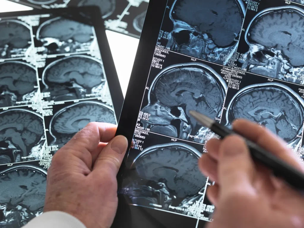 Tomografía cerebral – diagnostico acv isquemico