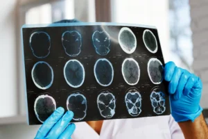 Enfermedad del Parkinson Tratamiento - Clínica de neurologia Robotica